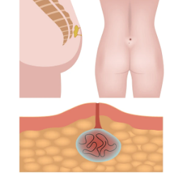 Ilustração do Cisto Pilonidal