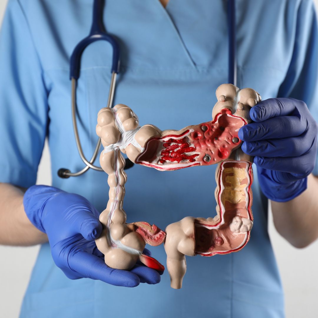 doença de crohn